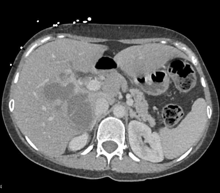 Necrotic Liver Metastases - CTisus CT Scan