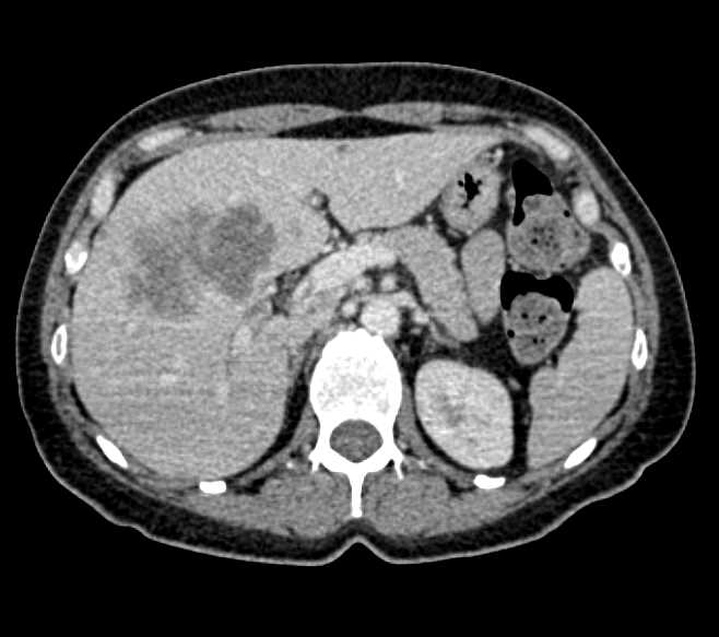 Metastatic Colon Cancer to Liver with Portal Adenopathy - CTisus CT Scan