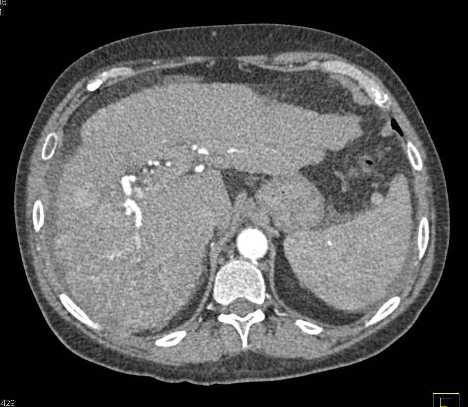 Cirrhosis with Multifocal Hepatocellular Carcinoma (Hepatoma) - CTisus CT Scan