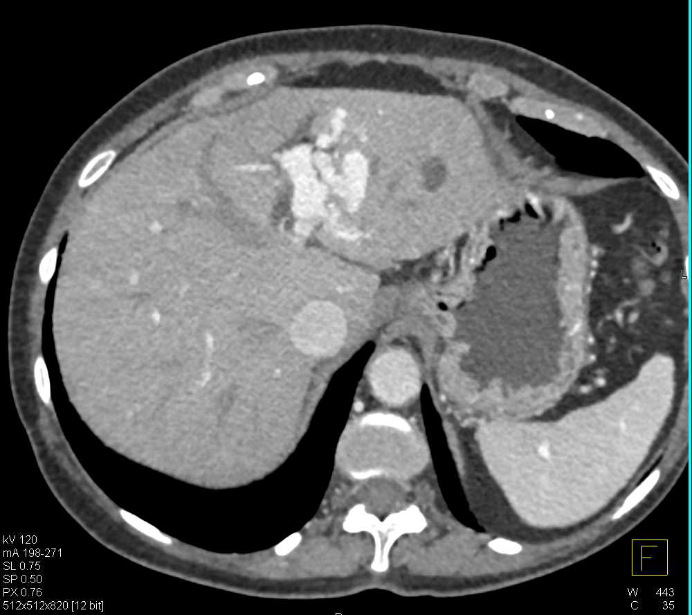 Arteriovenous (AV) Shunt in the Liver - CTisus CT Scan