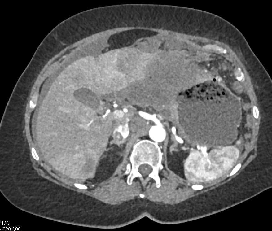 Gastric Adenocarcinoma with Liver Metastases and Carcinomatosis - CTisus CT Scan