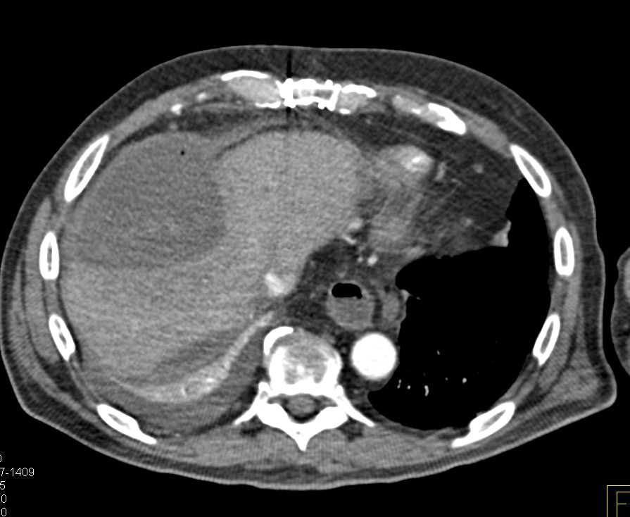 Biloma with Active Bleed - CTisus CT Scan