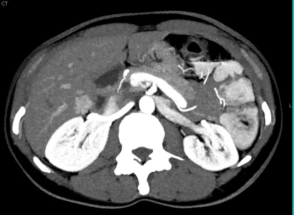 Small Stone in Common Bile Duct (CBD) - CTisus CT Scan