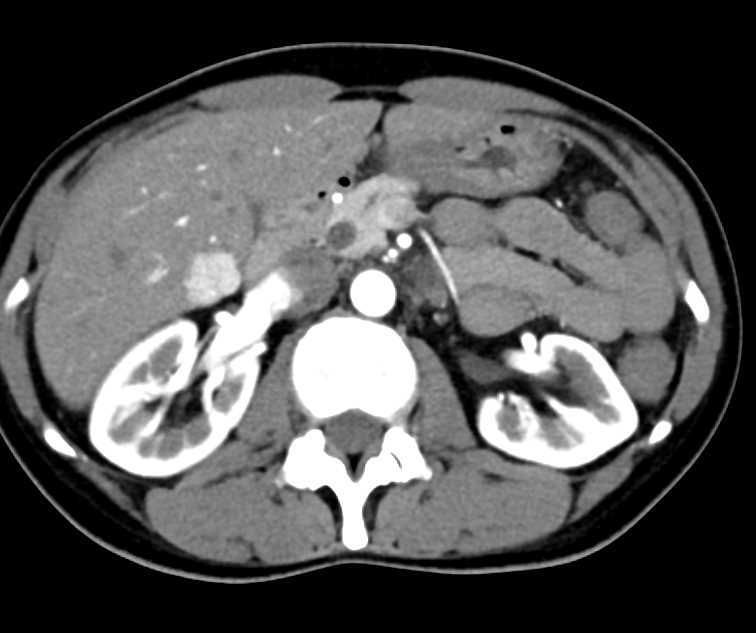 Dilated Distal Common Bile Duct (CBD) - CTisus CT Scan