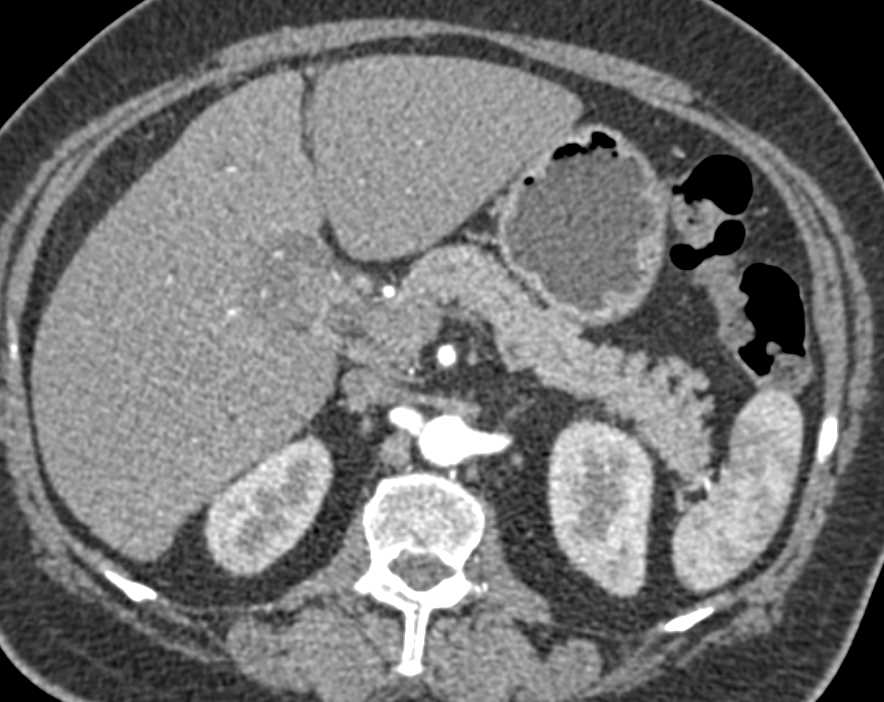 Gallbladder Cancer Involves the Common Bile Duct (CBD) - CTisus CT Scan