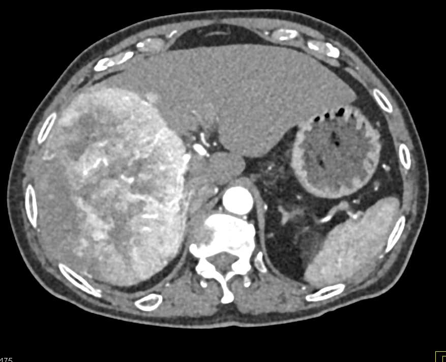 Hepatocellular Carcinoma (Hepatoma) with Neovascularity - CTisus CT Scan