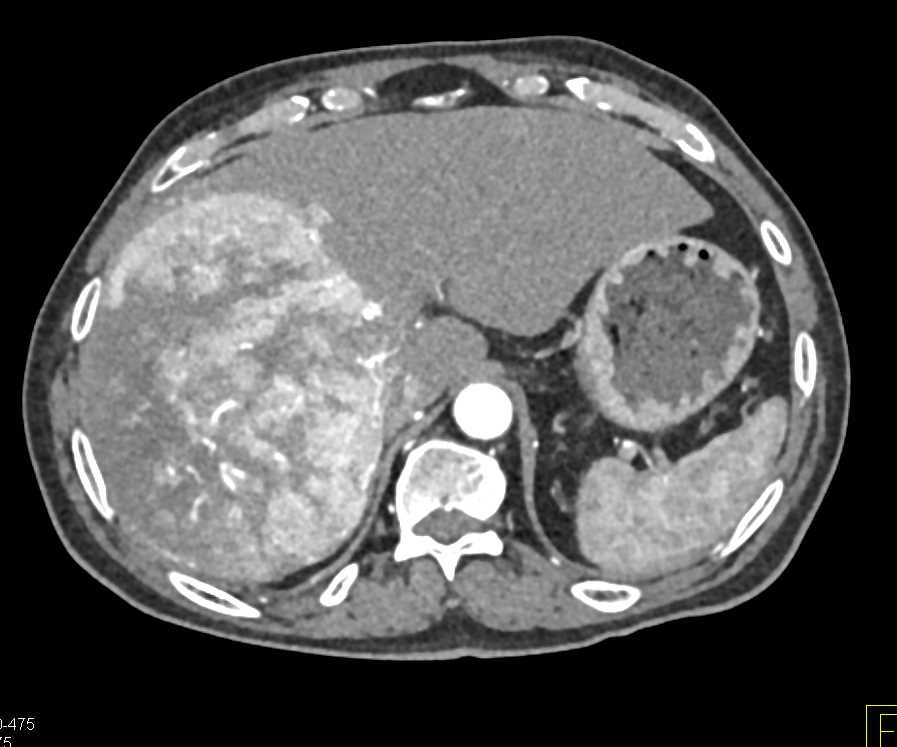 Hepatocellular Carcinoma (Hepatoma) with Neovascularity - CTisus CT Scan