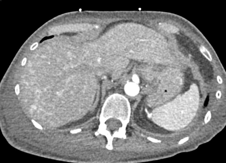 Metastatic Neuroendocrine Tumor to the Liver - CTisus CT Scan