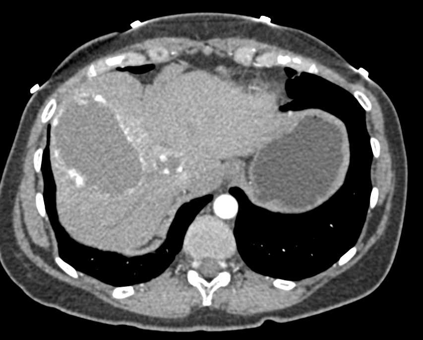 Hemangioma of the Liver - CTisus CT Scan