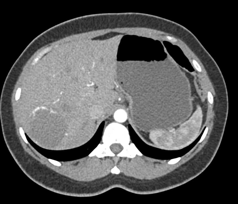 Hemangioma of the Liver - CTisus CT Scan