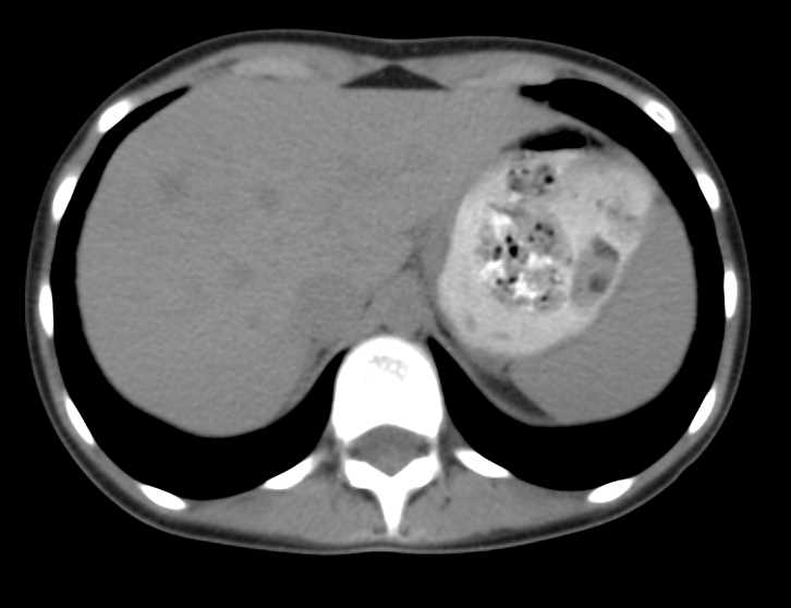 Focal Nodular Hyperplasia (FNH) - CTisus CT Scan