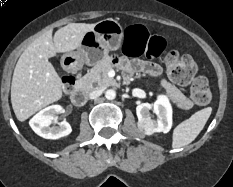 Hemangioma Liver - CTisus CT Scan