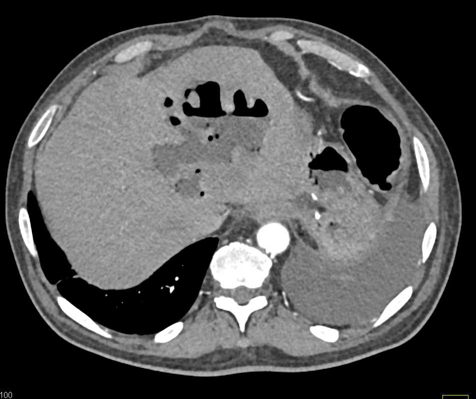 Liver Abscess with Air Fluid Level - CTisus CT Scan