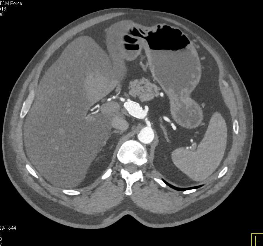 Calcified Hepatic Artery Aneurysm and Fatty Liver - CTisus CT Scan