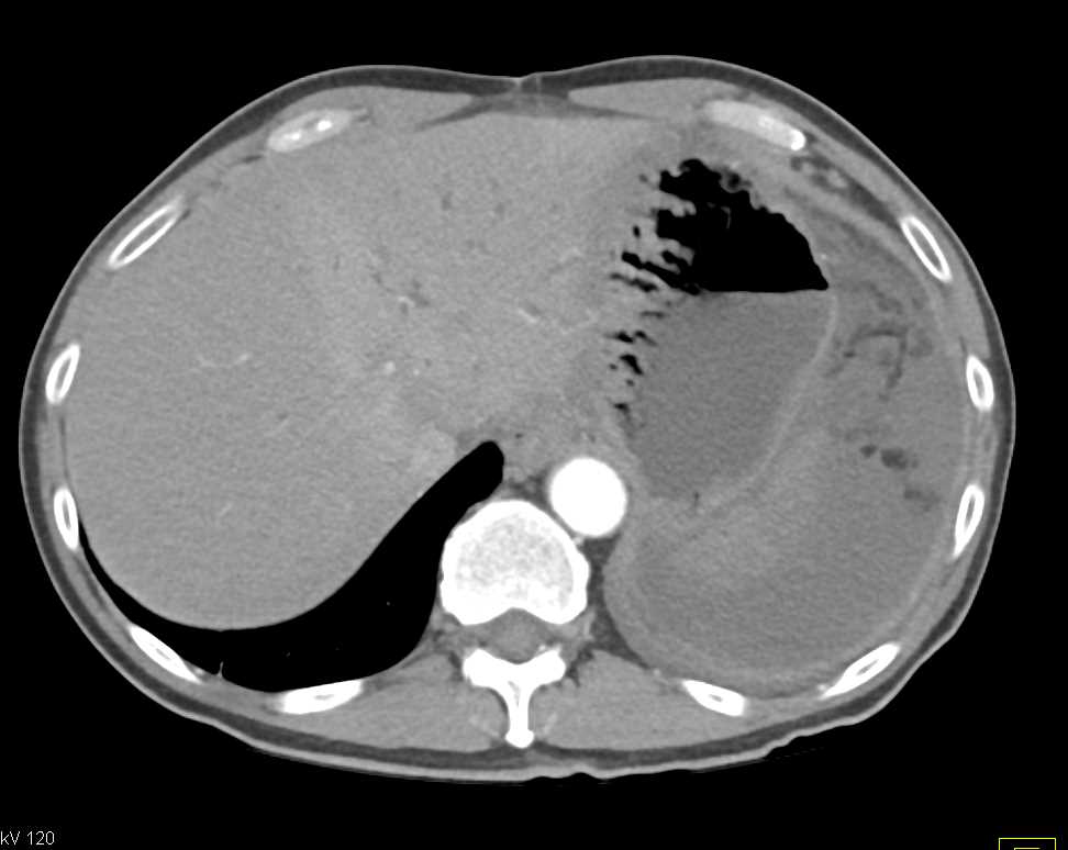 Dilated Ducts Left Lobe Liver due to Cholangiocarcinoma - CTisus CT Scan