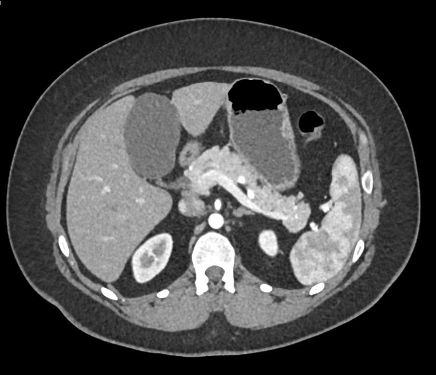 Biliary Cystadenoma Liver - CTisus CT Scan