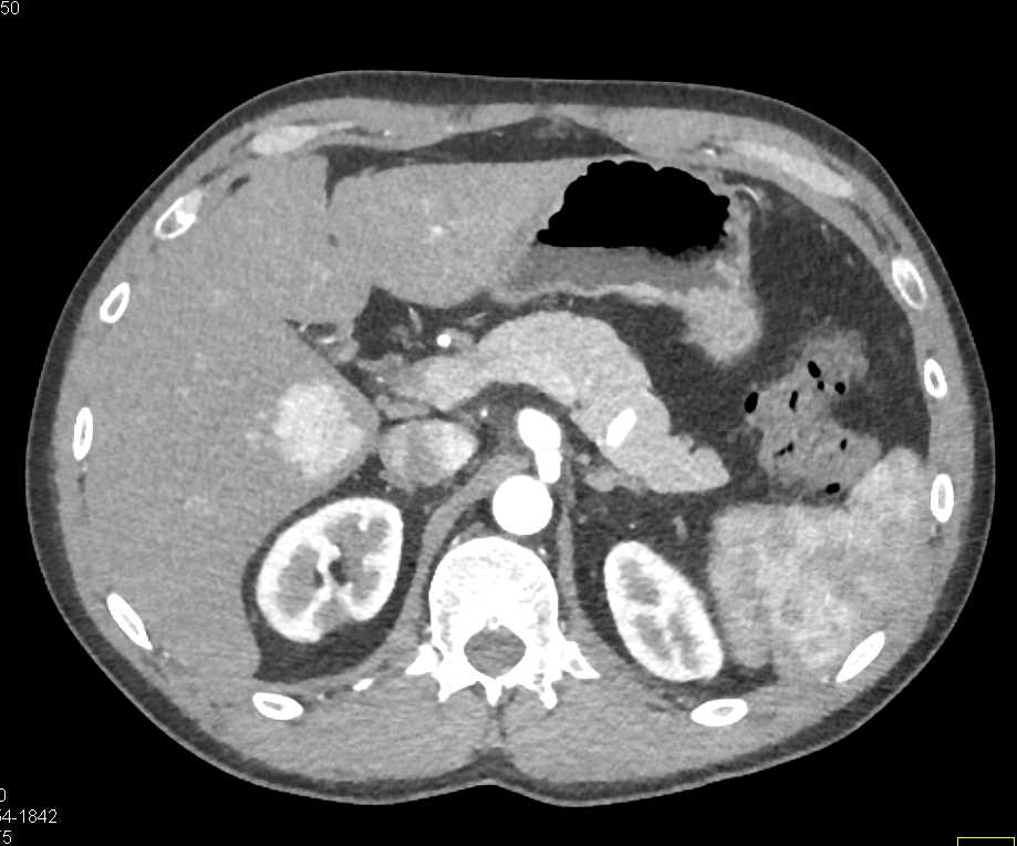 Focal Nodular Hyperplasia (FNH) Liver - CTisus CT Scan