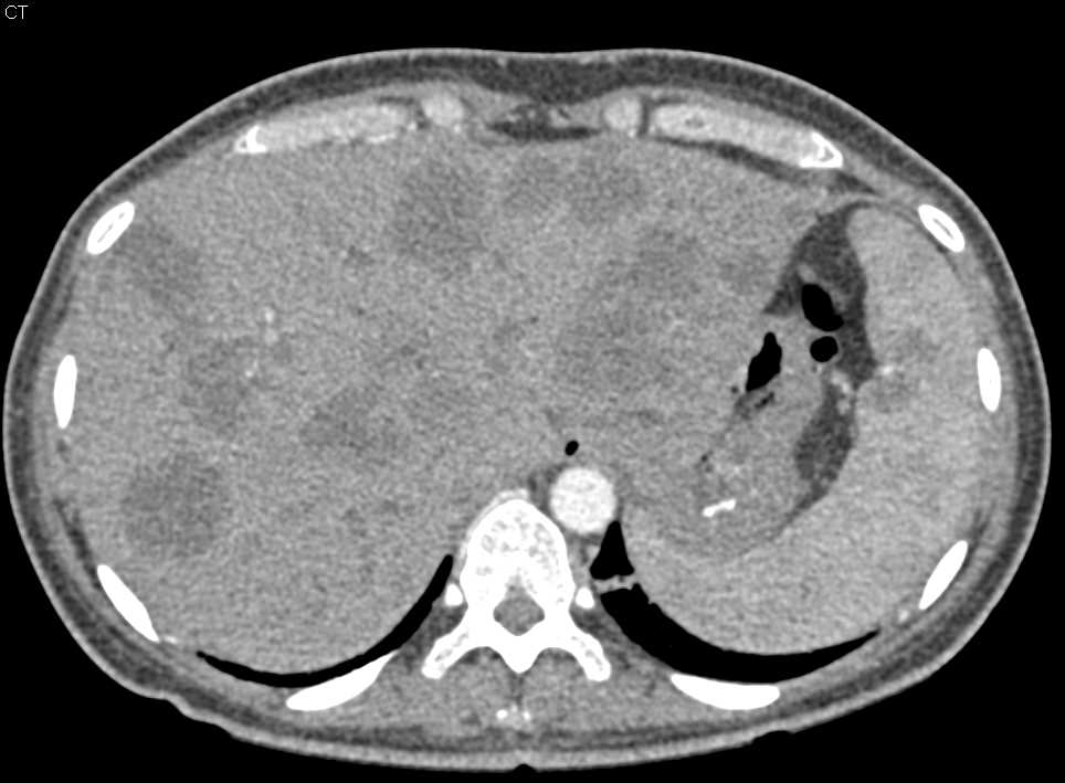 Liver and Splenic Metastases from Colon Cancer - CTisus CT Scan