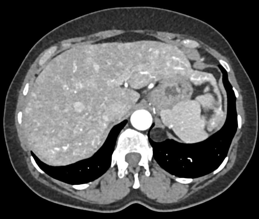 Arteriovenous (AV) Shunting in the Liver - CTisus CT Scan