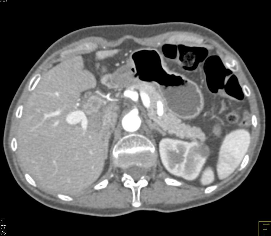 Cholangiocarcinoma Liver - CTisus CT Scan