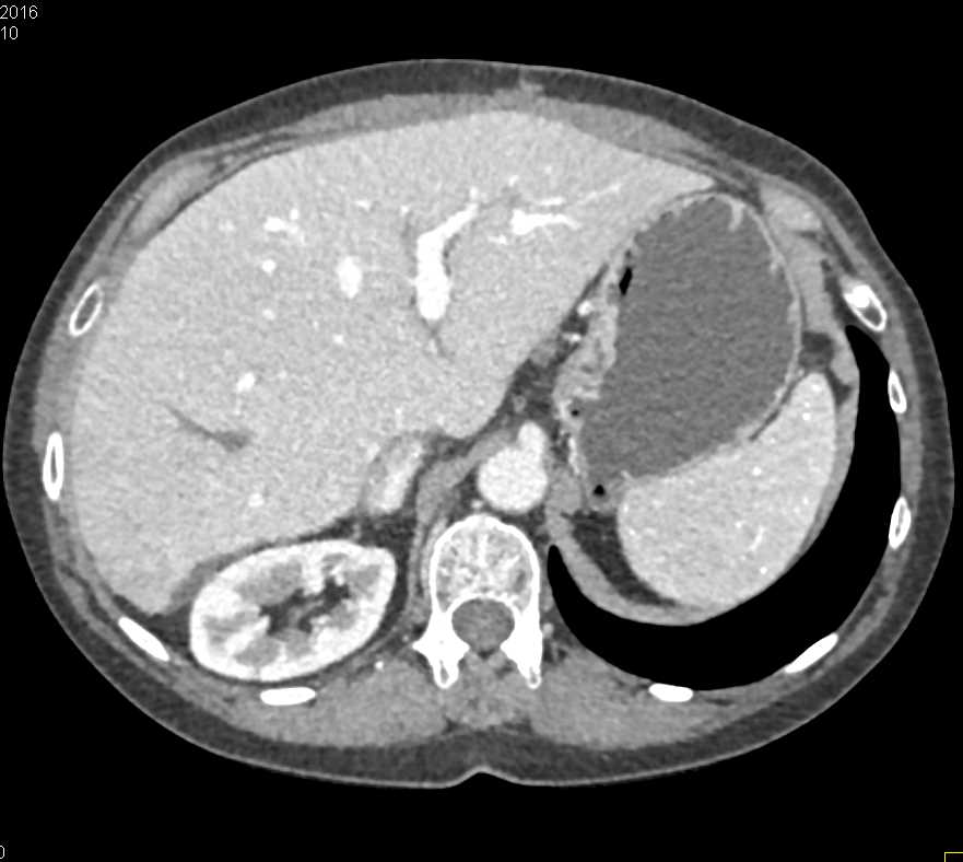 Occluded Right Hepatic Vein - CTisus CT Scan