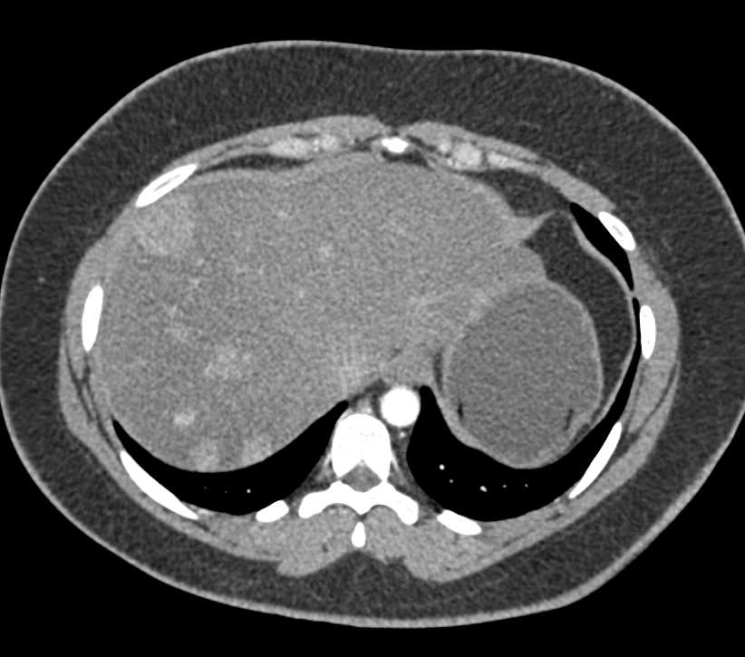 Regenerative Nodules in the Liver - CTisus CT Scan