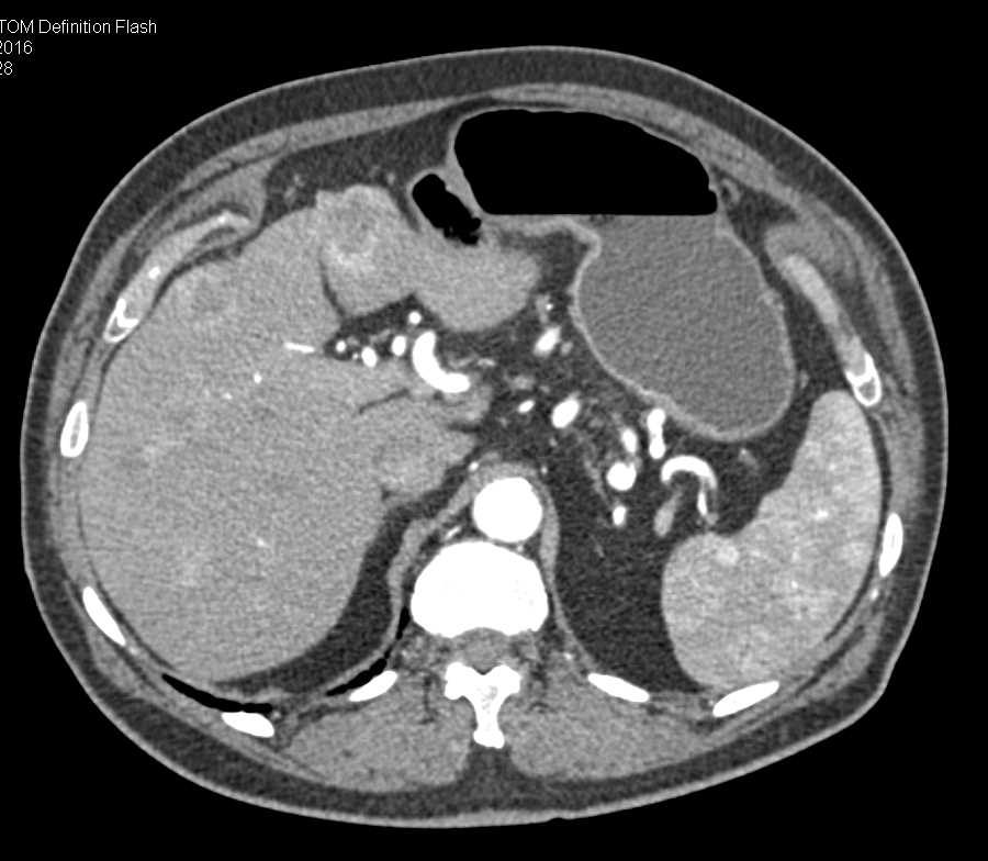 Metastatic Neuroendocrine Tumor to the Liver - CTisus CT Scan