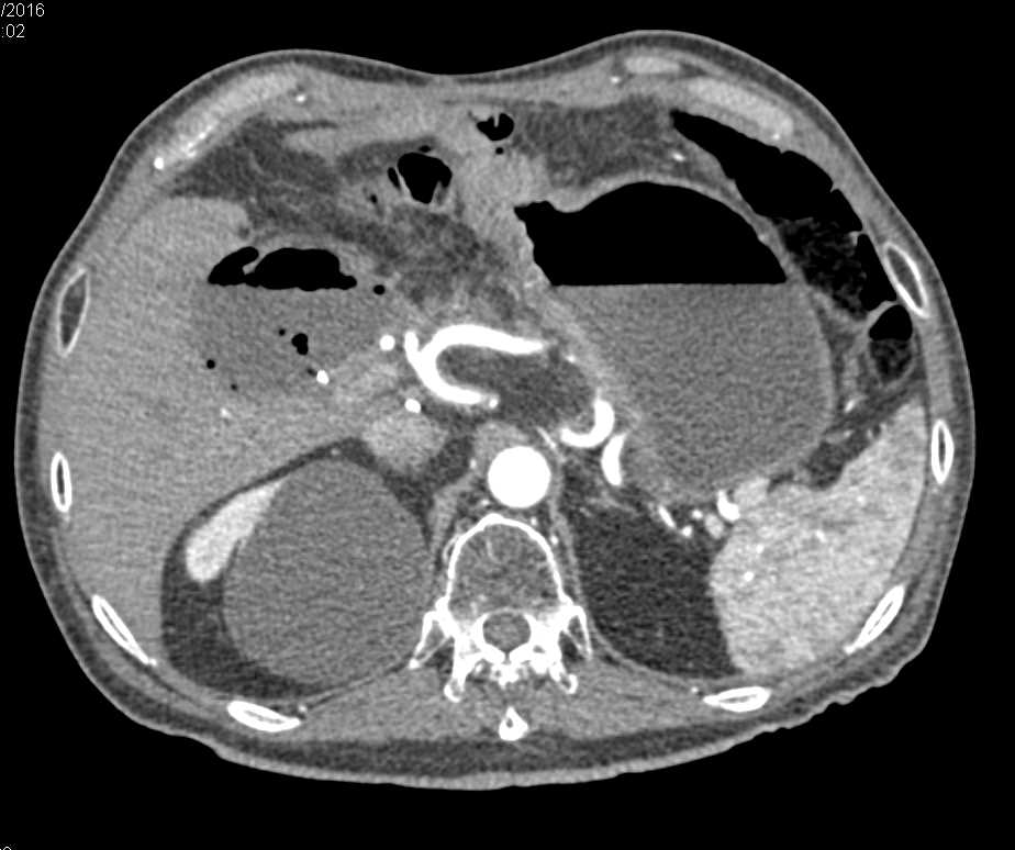 Abscess in Gallbladder Fossa - CTisus CT Scan