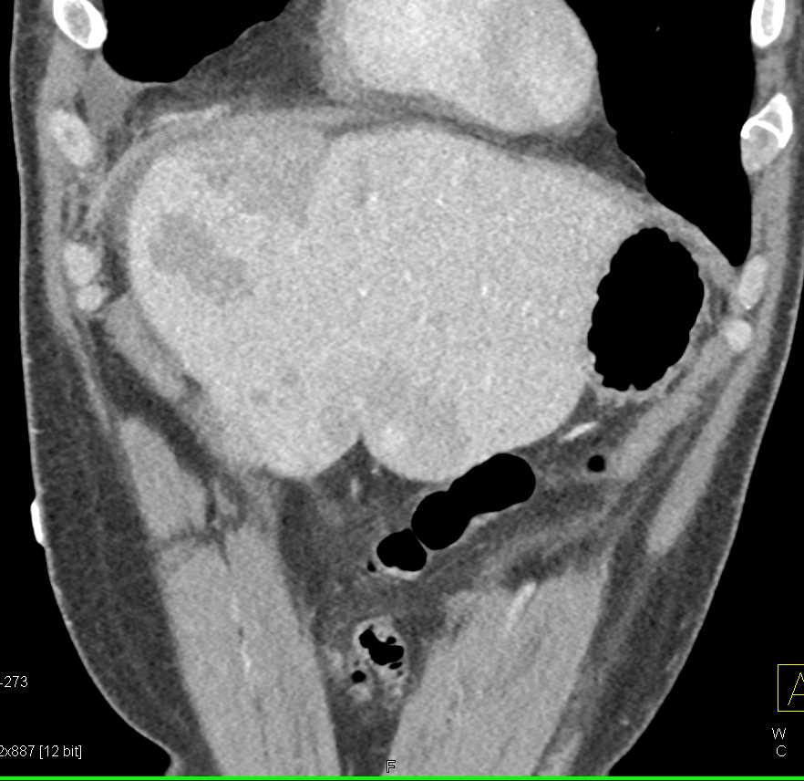 Implants on Liver Surface - CTisus CT Scan