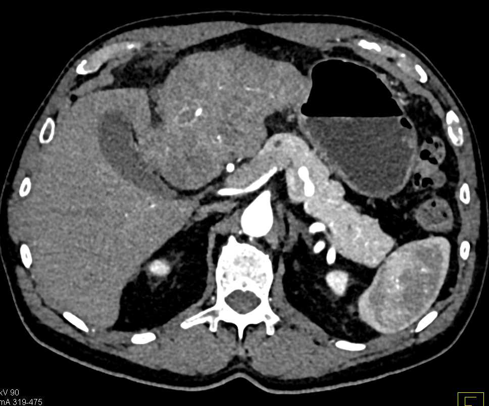 Hepatocellular Carcinoma (Hepatoma) with Neovascularity - CTisus CT Scan