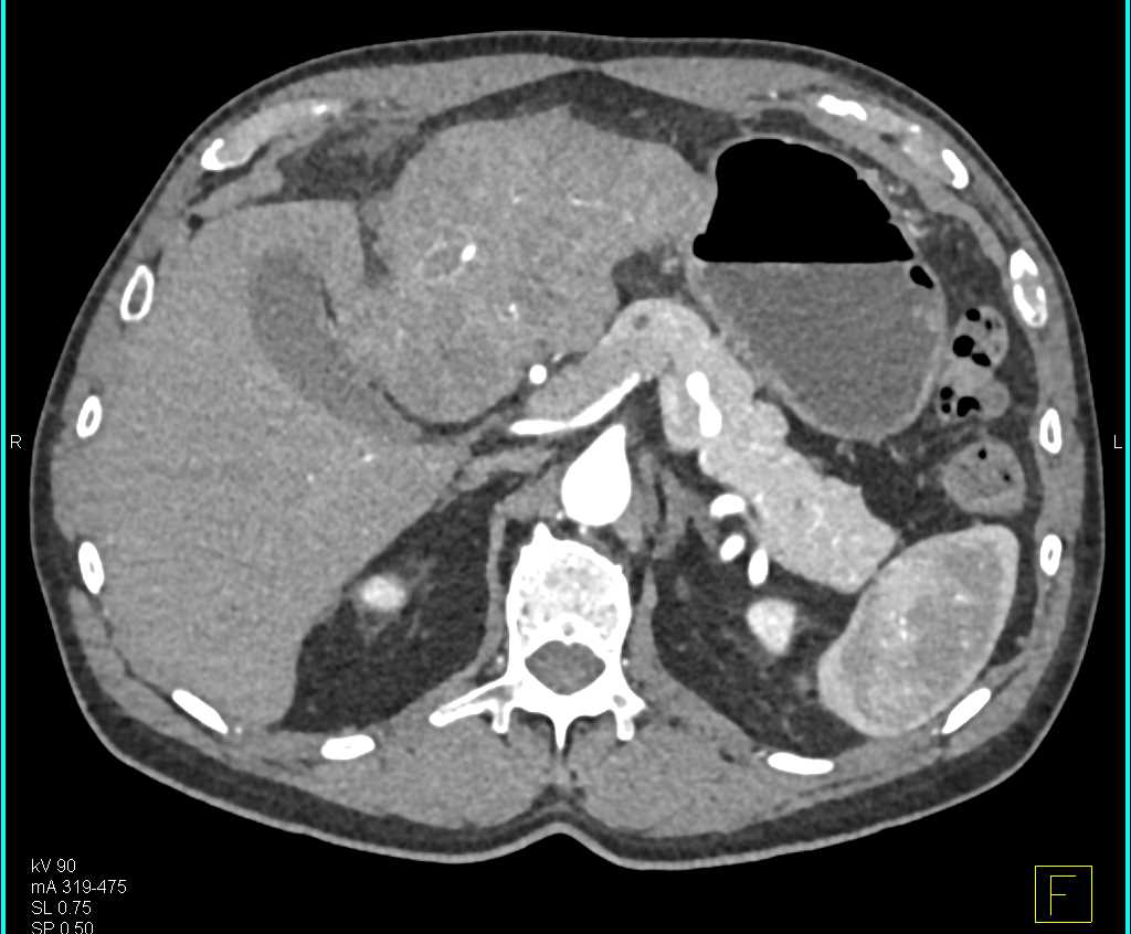 Hepatocellular Carcinoma (Hepatoma) with Neovascularity - CTisus CT Scan