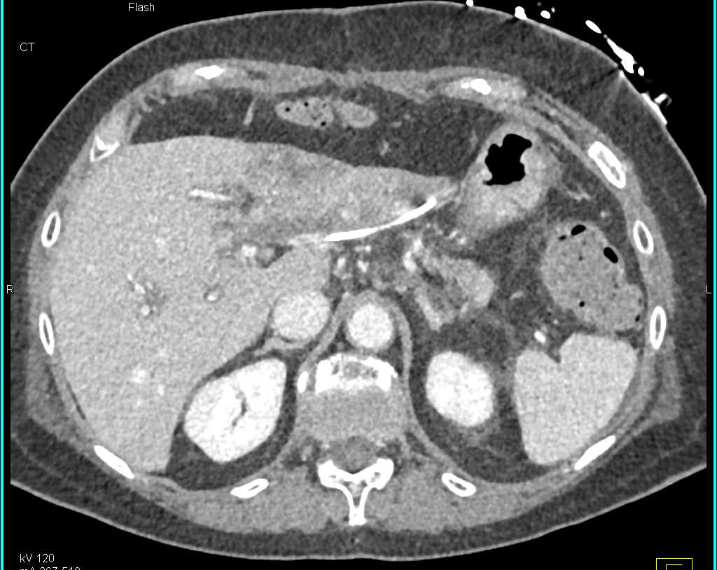 Infarct Left Lobe of the Liver - CTisus CT Scan