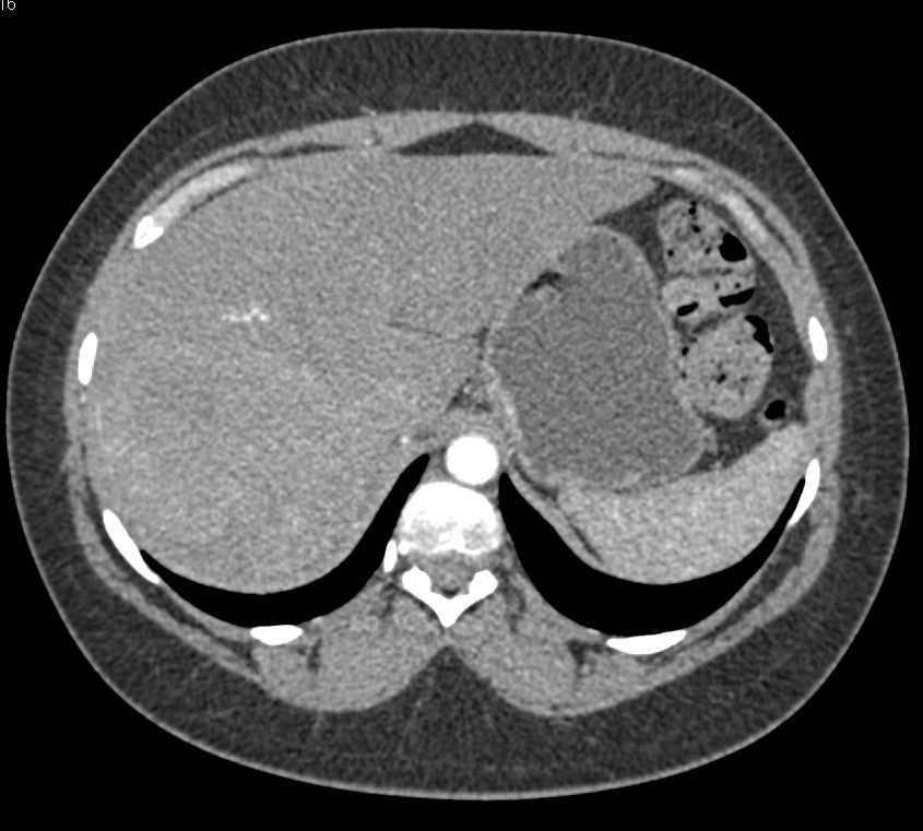 Hepatic Adenoma That Has Recently Bled - CTisus CT Scan