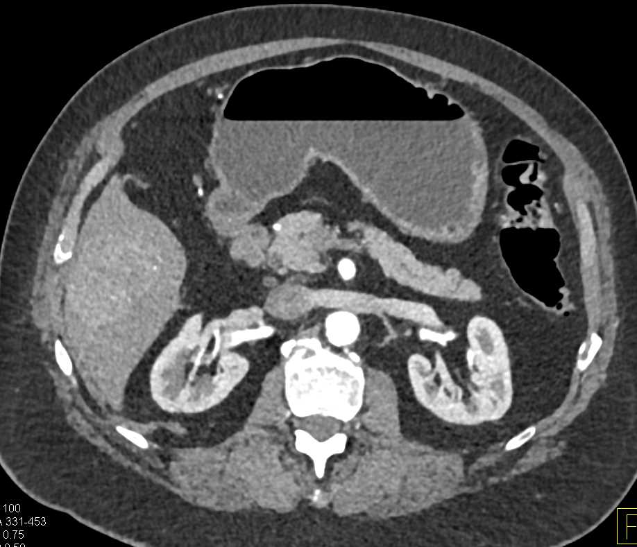 Focal Nodular Hyperplasia (FNH) Right Lobe of the Liver - CTisus CT Scan