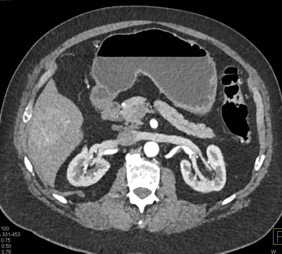 Focal Nodular Hyperplasia (FNH) Right Lobe of the Liver - CTisus CT Scan