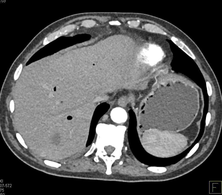 Liver Abscess s/p Stenting - CTisus CT Scan