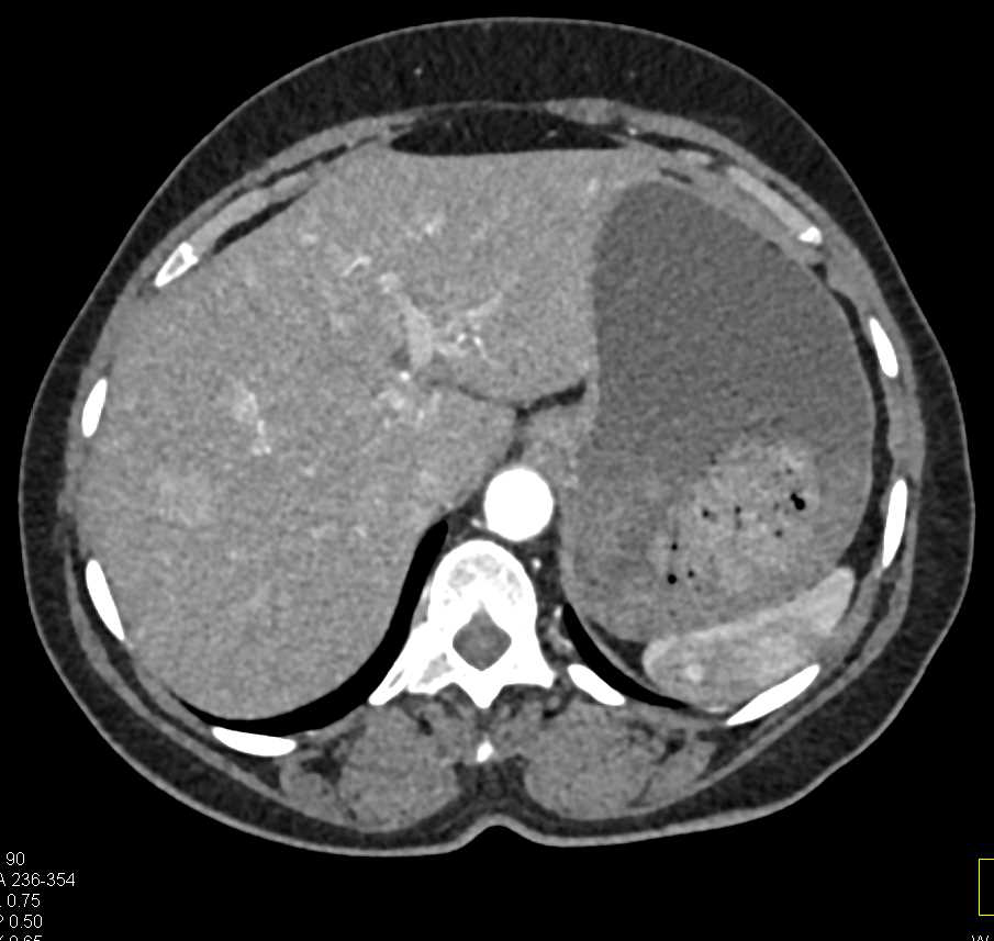 AV Shunting in the Liver - CTisus CT Scan