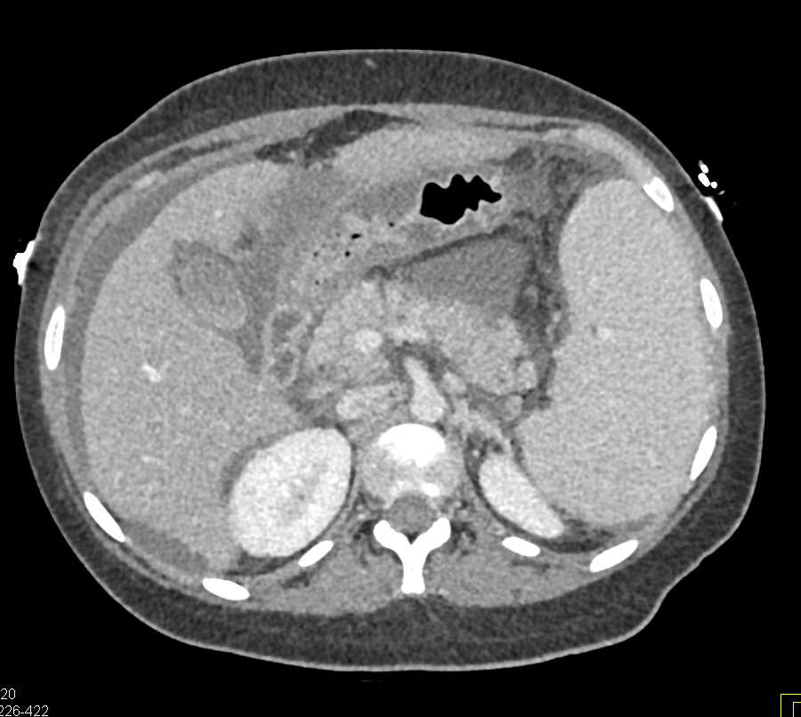 Cirrhosis with Portal Hypertension and Gastritis - CTisus CT Scan