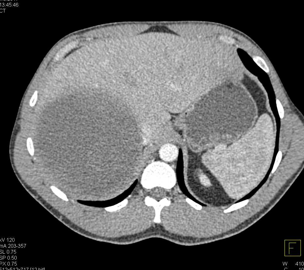 Cystic Metastases to the Liver - CTisus CT Scan