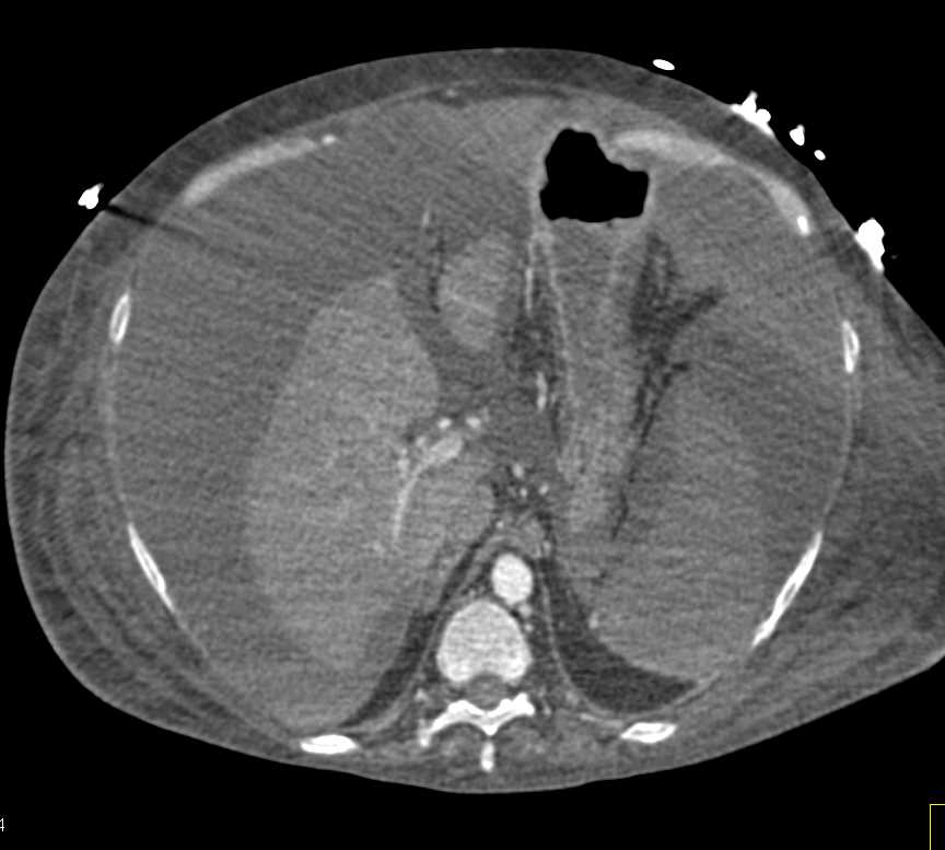 Cirrhosis with Ascites and Splenic Infarction - CTisus CT Scan