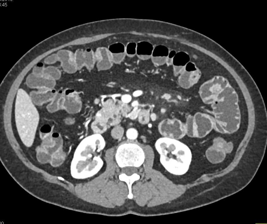 Mucinous Cystic Neoplasm (MCN) - CTisus CT Scan