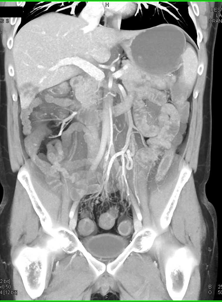 Liver Metastases from Colon Cancer - CTisus CT Scan