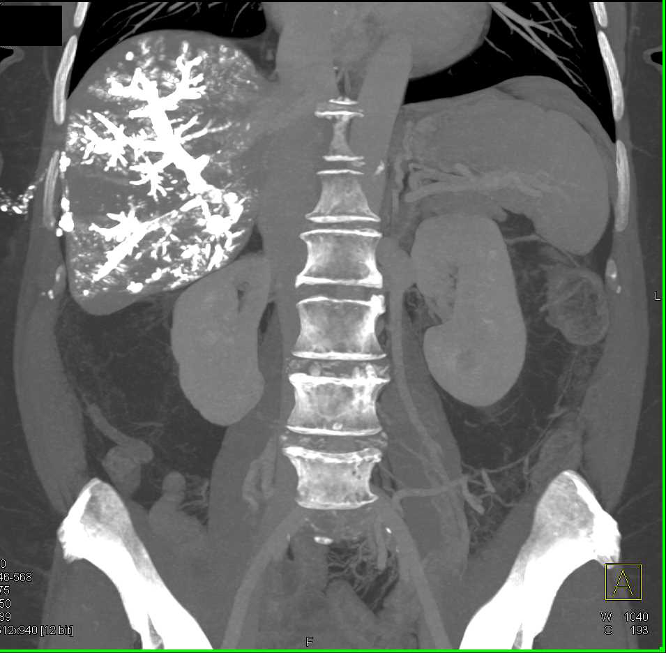 Contrast Injected into the Hepatic Vascular System for Chemotherapy Delivery - CTisus CT Scan