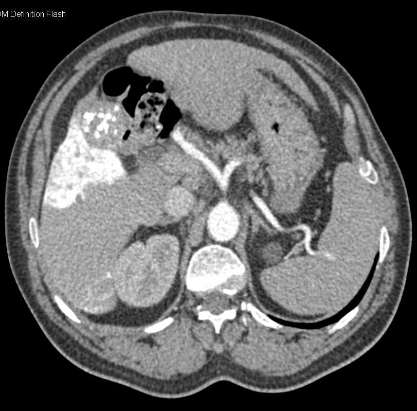 Cirrhosis and Transjugular Intrahepatic Portosystemic Shunt (TIPS) Injection - CTisus CT Scan