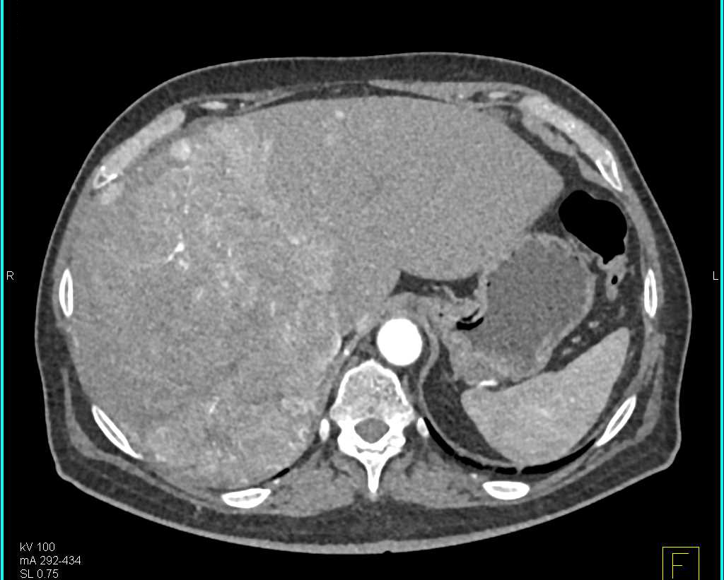 Hepatocellular Carcinoma (Hepatoma) with Extensive Neovascularity - CTisus CT Scan