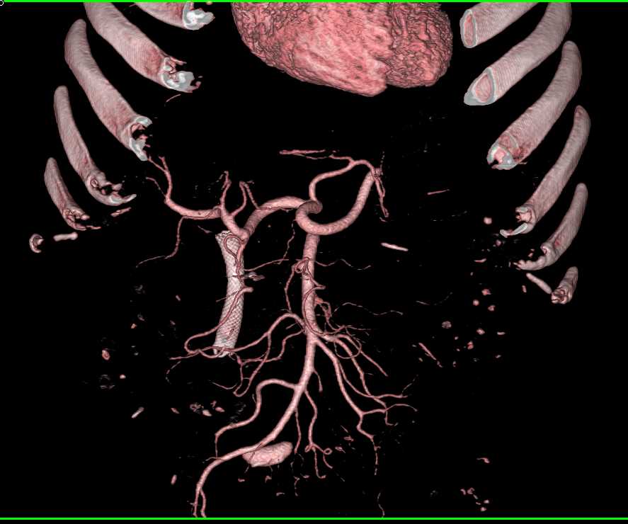 Stent in the Common Bile Duct - CTisus CT Scan