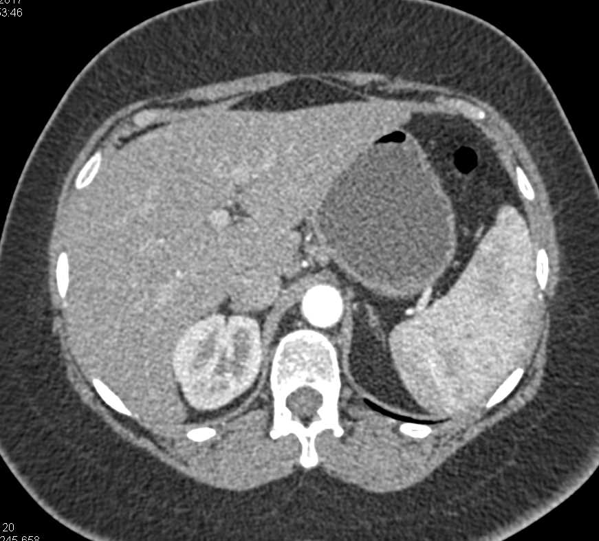 Hemangioma of the Liver - CTisus CT Scan