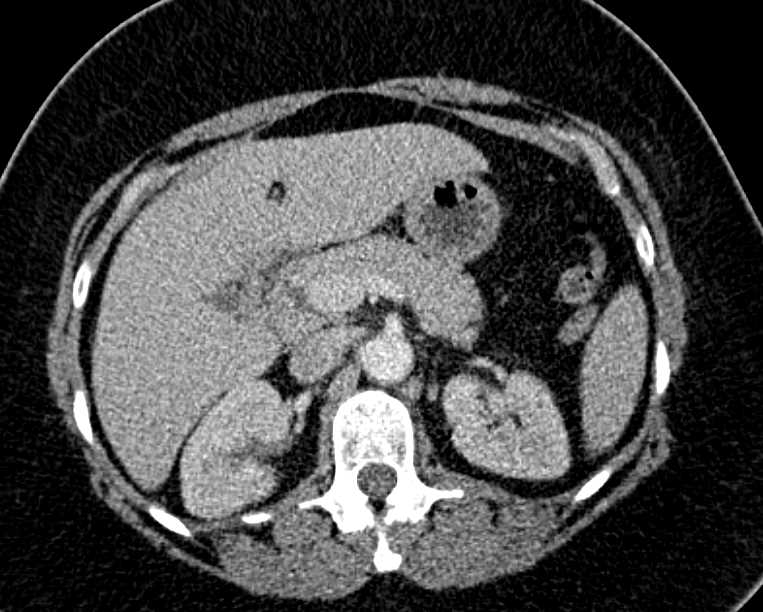 Hepatic Adenoma with Perihepatic Bleed - CTisus CT Scan