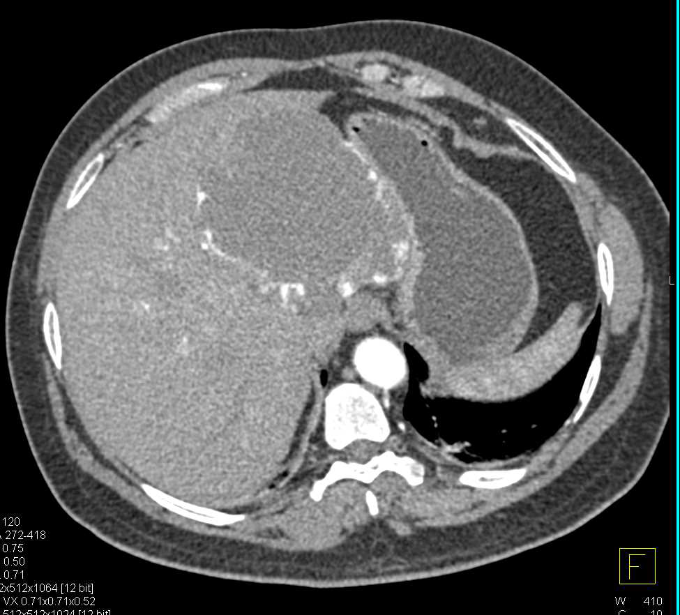 Hemangioma of the Liver - CTisus CT Scan