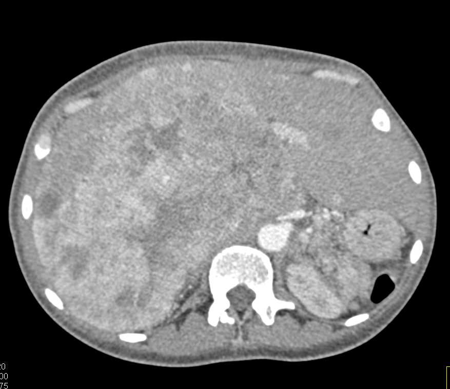 Neuroendocrine Tumor Metastatic to the Liver - CTisus CT Scan